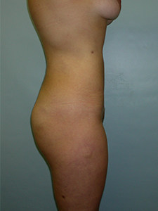 Liposuction Before and After Pictures Miami, FL