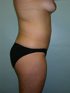 Liposuction Before and After Pictures Miami, FL