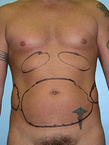 Liposuction Before and After Pictures Miami, FL