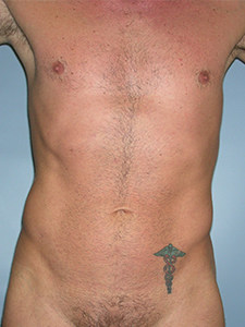 Liposuction Before and After Pictures Miami, FL