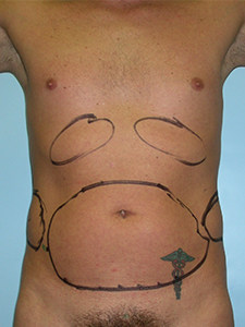 Liposuction Before and After Pictures Miami, FL