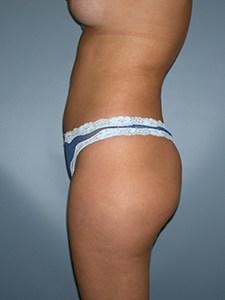 Liposuction Before and After Pictures Miami, FL