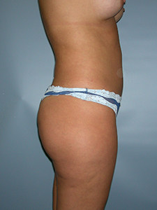 Liposuction Before and After Pictures Miami, FL