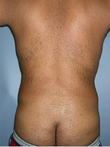 Liposuction Before and After Pictures Miami, FL