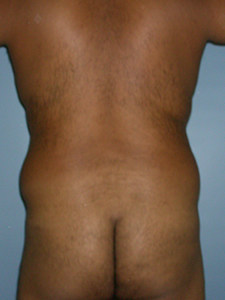 Liposuction Before and After Pictures Miami, FL