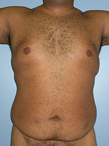 Liposuction Before and After Pictures Miami, FL