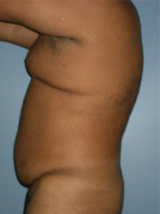 Liposuction Before and After Pictures Miami, FL