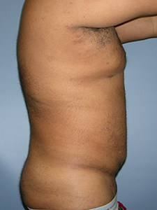 Liposuction Before and After Picture Miami, FL