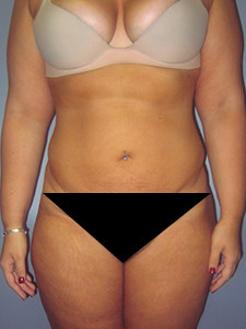 Liposuction Before and After Pictures Miami, FL