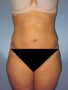 Liposuction Before and After Pictures Miami, FL