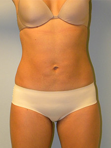 Liposuction Before and After Pictures Miami, FL