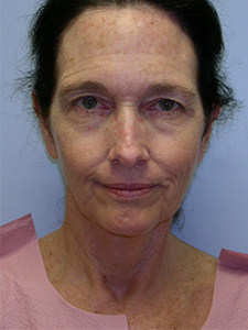 Neck Lift Before and After Pictures Miami, FL