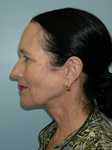 Neck Lift Before and After Pictures Miami, FL