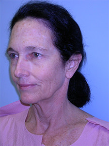 Neck Lift Before and After Pictures Miami, FL