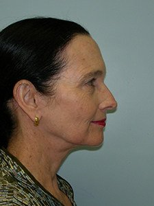 Neck Lift Before and After Pictures Miami, FL