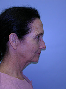 Neck Lift Before and After Pictures Miami, FL