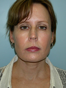 Neck Lift Before and After Pictures Miami, FL