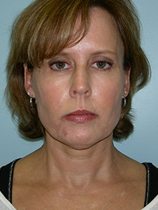 Neck Lift Before and After Pictures Miami, FL