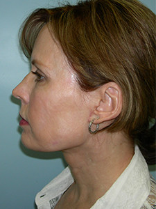 Neck Lift Before and After Pictures Miami, FL