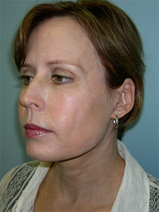 Neck Lift Before and After Pictures Miami, FL