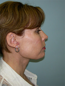 Neck Lift Before and After Pictures Miami, FL