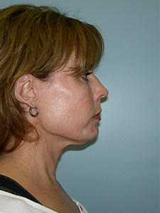 Neck Lift Before and After Pictures Miami, FL