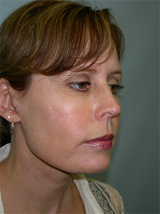 Neck Lift Before and After Pictures Miami, FL