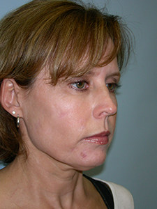 Neck Lift Before and After Pictures Miami, FL