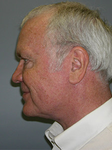 Neck Lift Before and After Pictures Miami, FL