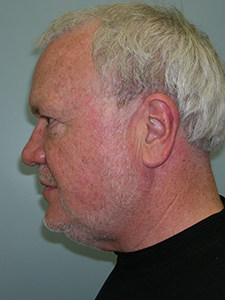 Neck Lift Before and After Pictures Miami, FL