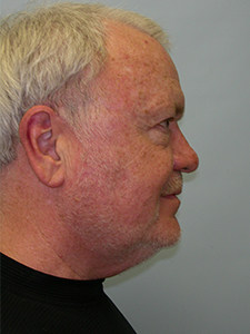 Neck Lift Before and After Pictures Miami, FL