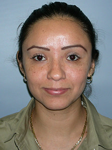 Otoplasty Before and After Pictures Miami, FL