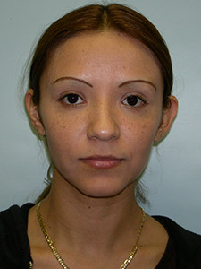 Otoplasty Before and After Pictures Miami, FL