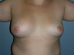 Revision Breast Augmentation Before and After Pictures Miami, FL