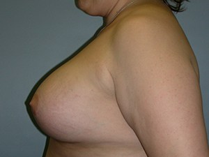 Revision Breast Augmentation Before and After Pictures Miami, FL