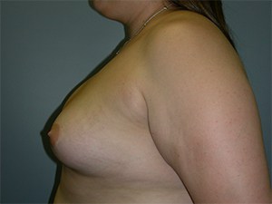 Revision Breast Augmentation Before and After Pictures Miami, FL