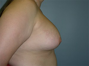 Revision Breast Augmentation Before and After Pictures Miami, FL