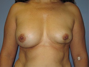 Revision Breast Augmentation Before and After Pictures Miami, FL