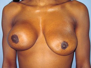 Revision Breast Augmentation Before and After Pictures Miami, FL