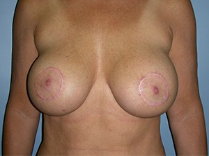 Revision Breast Augmentation Before and After Pictures Miami, FL