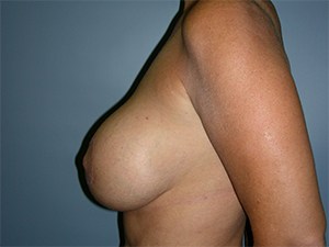 Revision Breast Augmentation Before and After Pictures Miami, FL