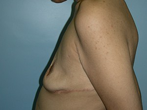 Revision Breast Augmentation Before and After Pictures Miami, FL