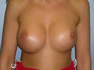 Revision Breast Augmentation Before and After Pictures Miami, FL