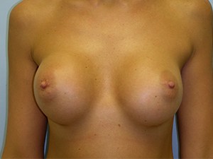 Revision Breast Augmentation Before and After Pictures Miami, FL