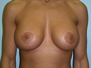 Revision Breast Augmentation Before and After Pictures Miami, FL