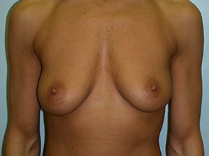 Revision Breast Augmentation Before and After Pictures Miami, FL