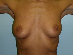 Revision Breast Augmentation Before and After Pictures Miami, FL