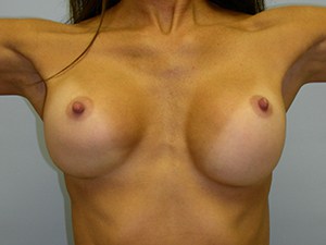 Revision Breast Augmentation Before and After Pictures Miami, FL