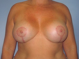 Revision Breast Augmentation Before and After Pictures Miami, FL