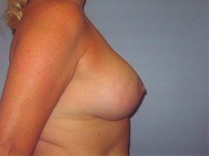 Revision Breast Augmentation Before and After Pictures Miami, FL